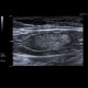 Lymph nodes, chronic: US - Ultrasound